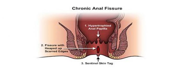 Anal Fissure Surgery