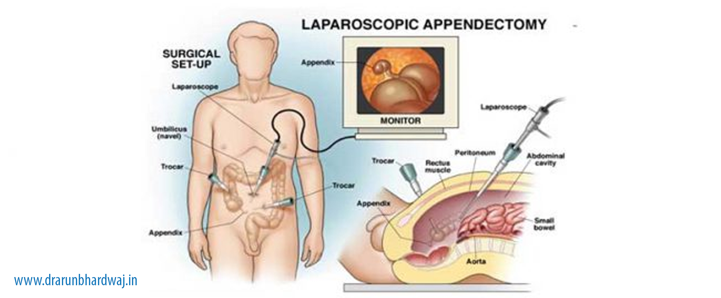 LAPAROSCOPIC APPENDECTOMY /APPENDICITIS