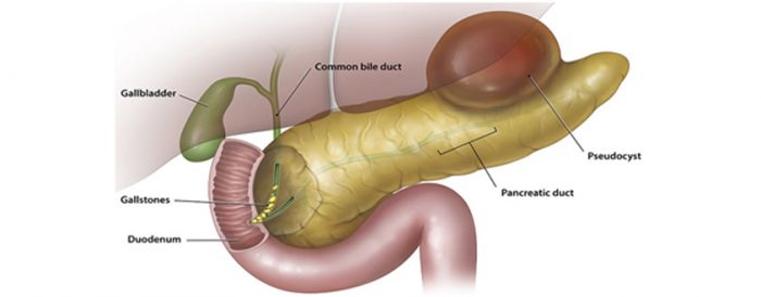 Pseudocyst Pancreas