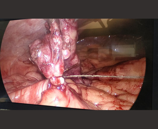 Laparoscopic surgery for perforated appendicitis