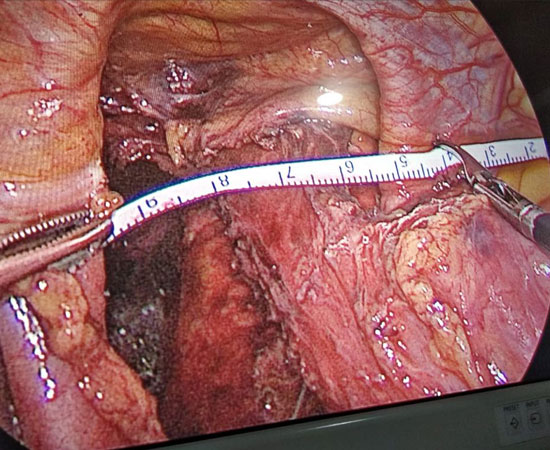 laparoscopic Repair of Large hiatus hernia