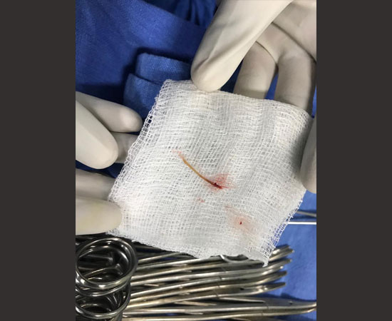 laparoscopic surgery for fish bone perforation of intestine