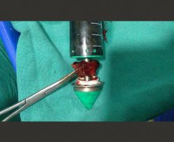 TAR procedure for recurrent incisional hernia