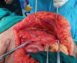 TAR PROCEDURE FOR RECURRENT INCISIONAL HERNIA