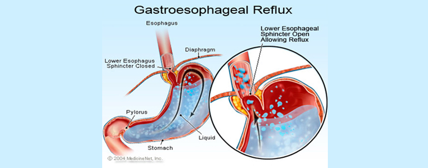 Gastroesophageal Reflux