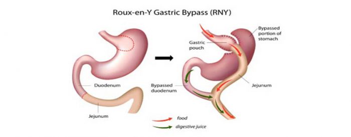 Lap Roux-en-Y Gastric Bypass