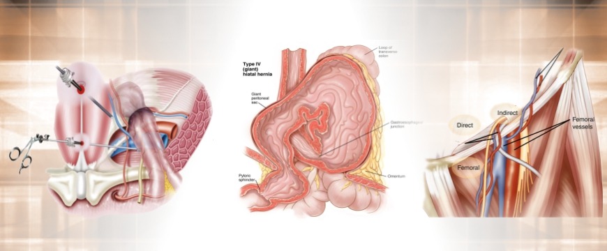 Laparoscopic Hernia Surgery