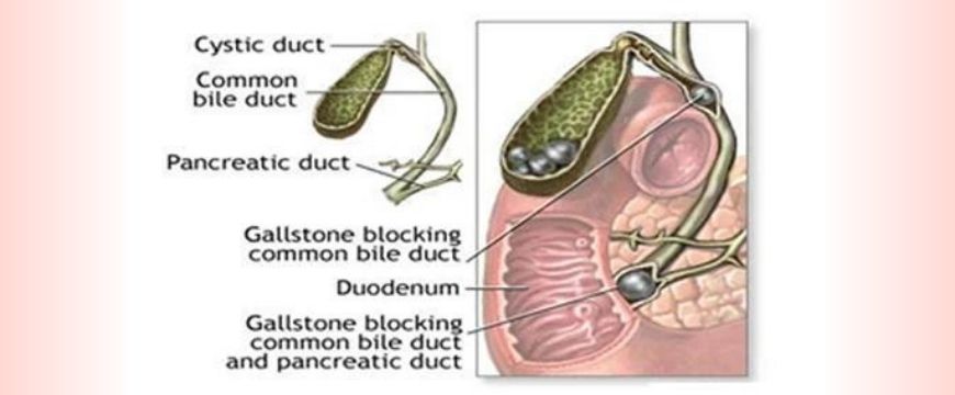 CBD STONES AND LAPAROSCOPIC SURGERY FOR CBD STONES