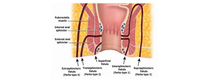 Anal Fistula Treatment