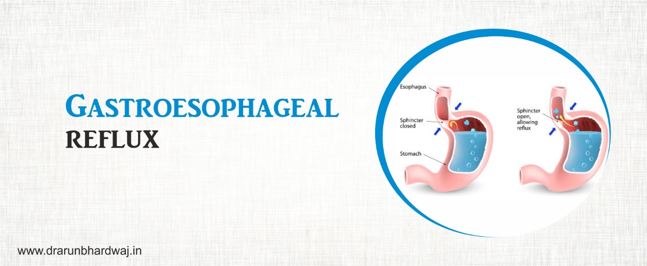 gastroesophageal