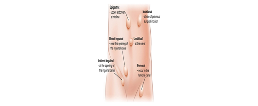 HERNIA IS A SWELLING IN THE GROIN, UPPER THIGH, NAVEL REGION OR AT THE SITE OF PREVIOUS SURGERY IN ABDOMEN.