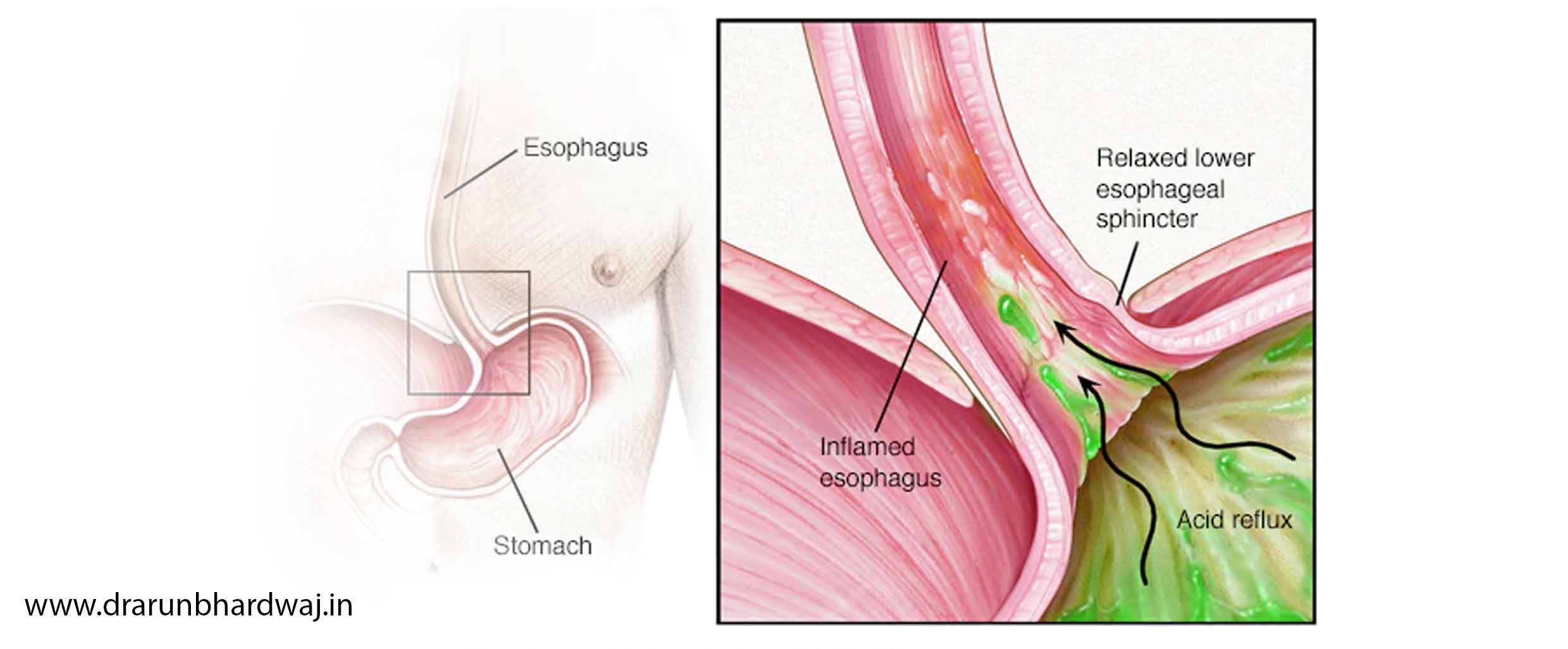 REFLUX DISEASE