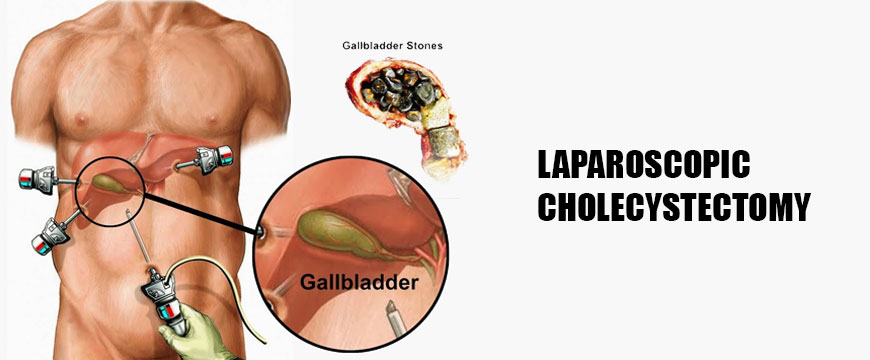 SIGNS AND SYMPTOMS FOR CHOLECYSTECTOMY