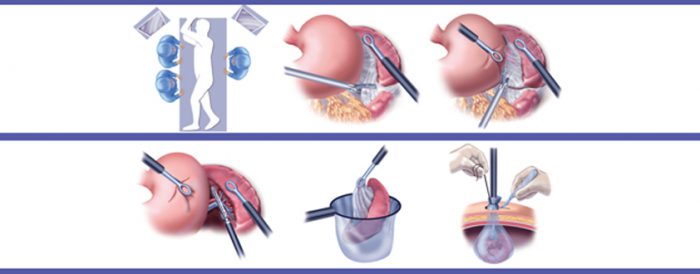 Laparoscopic for Splenectomy