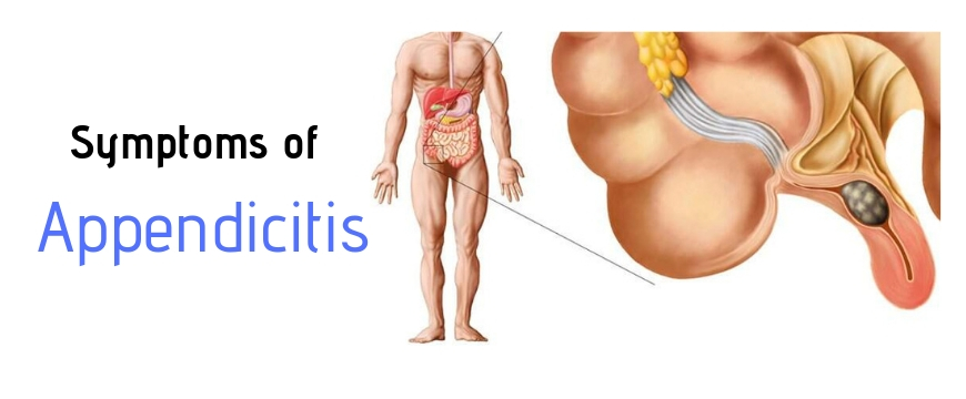 SYMPTOMS OF APPENDICITIS