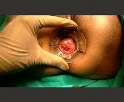 TAR procedure for recurrent incisional hernia