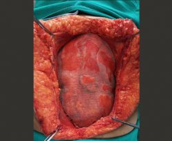 TAR PROCEDURE FOR RECURRENT INCISIONAL HERNIA