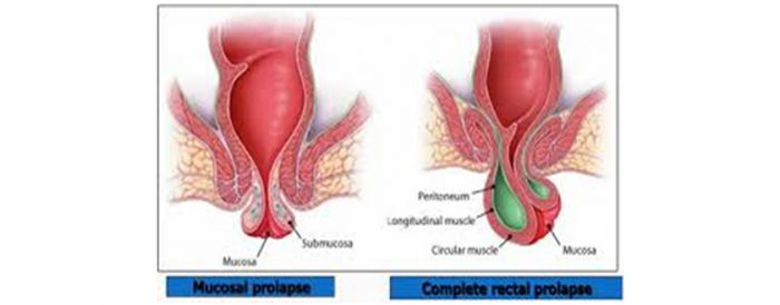 Rectal Prolapse