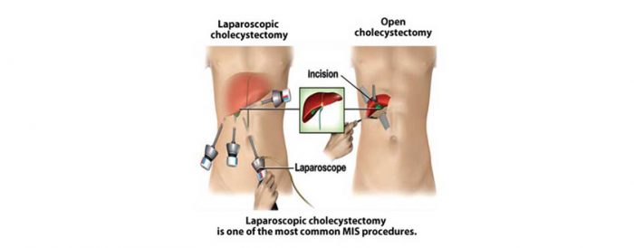 Gallstones