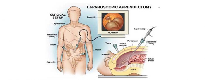 appendicitis