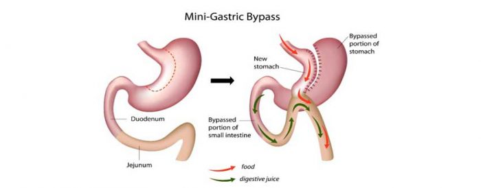 Mini-Gastric Bypass