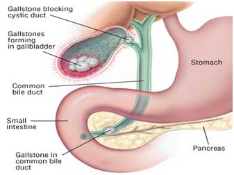 Gallstones surgeon In Dwarka, west delhi