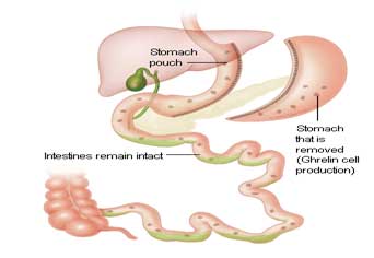 LAPAROSCOPIC SLEEVE GASTRECTOMY